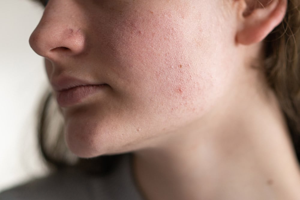 Trądzik Różowaty (Rosacea): objawy, przyczyny i skuteczne metody leczenia