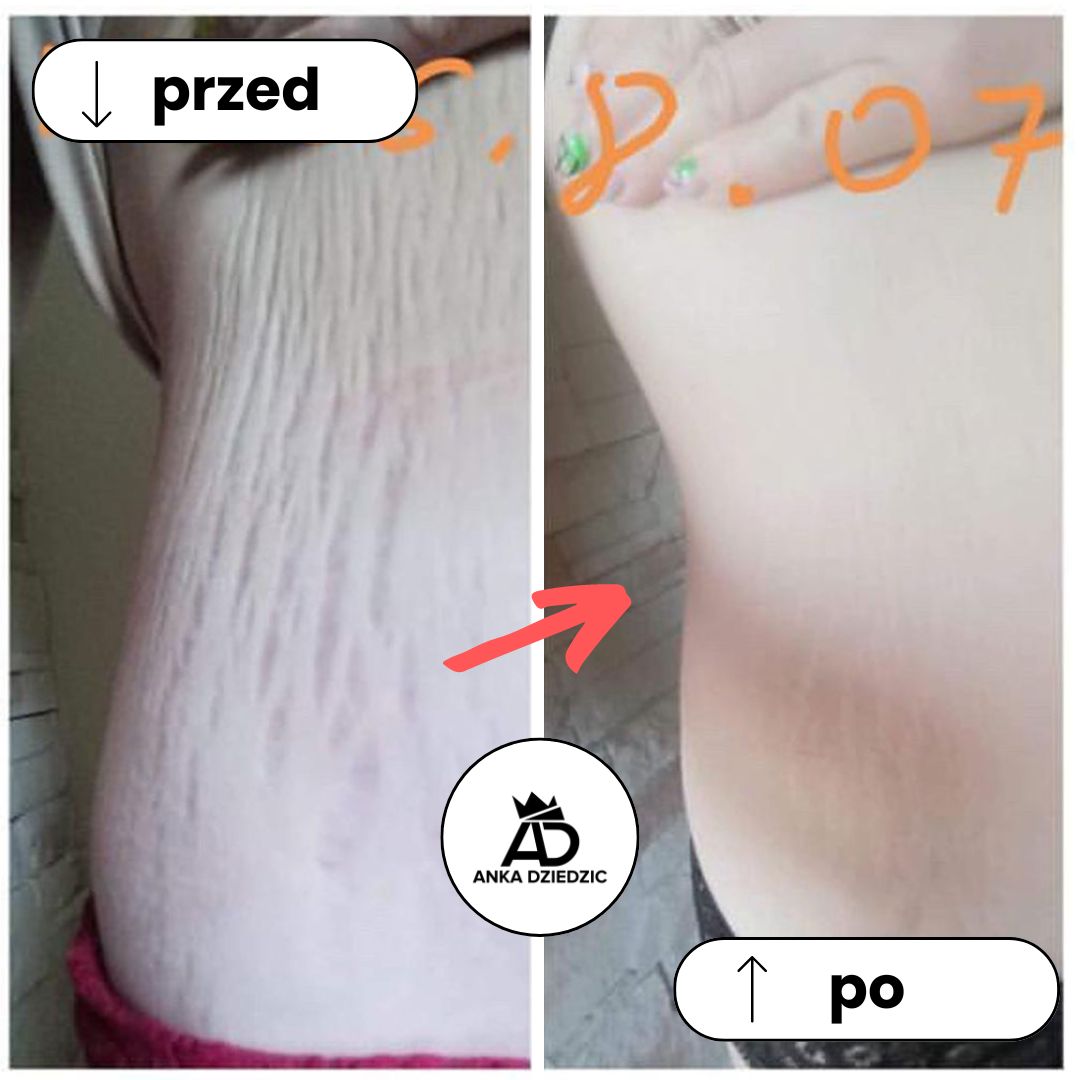 FitLab Olejek Na Rozstępy o Działaniu Antycellulitowym