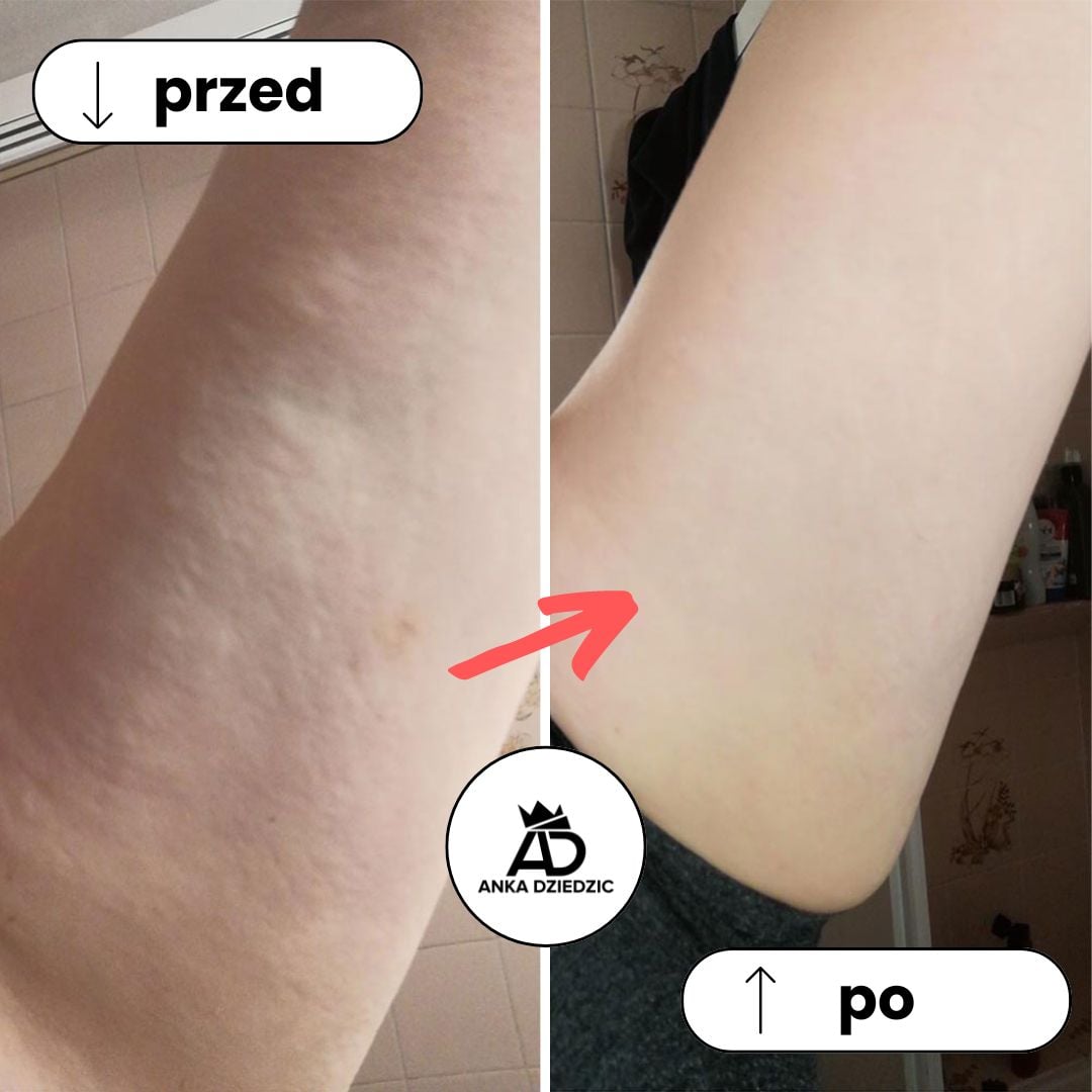 FitLab Olejek Na Rozstępy o Działaniu Antycellulitowym
