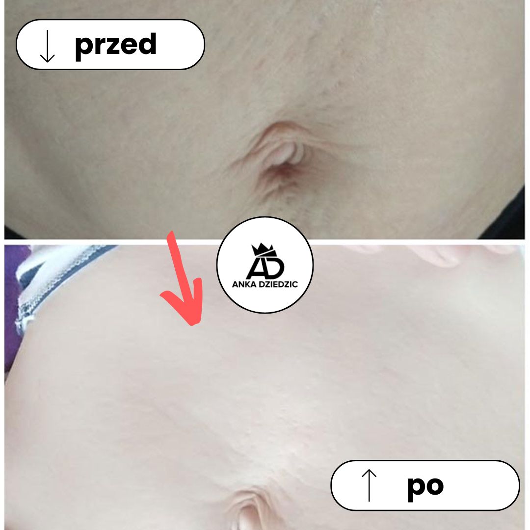 FitLab Olejek Na Rozstępy o Działaniu Antycellulitowym